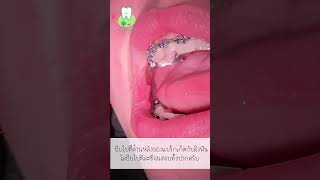 ขั้นตอนการถอดเครื่องมือจัดฟัน :: Dentist Tony #ดัดฟัน #จัดฟัน