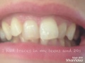 Adult Braces Before And After Time Lapse Photos 0 - 2 Months Adult Braces Before And After Time Lapse Photos 0 - 2 Months