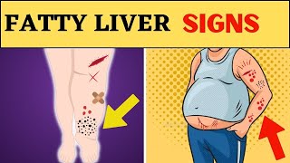Top 10 Signs and Symptoms of Fatty Liver Disease