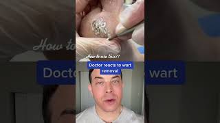 HUGE plantar wart removal! | 208SkinDoc