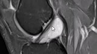 ACL Cyst