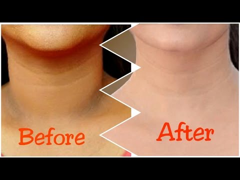 How To Get Rid of Dark Neck in 15 Minutes | Fast and Quickly How To Get Rid of Dark Neck in 15 Minutes | Fast and Quickly