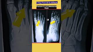 Metatarsal Fracture | X-Ray Foot #shorts #xray #radiography #fracture #radiographerusn