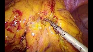 Laparoscopic Sigmoid Colectomy with Inferior Mesenteric Artery Preservation for Diverticular Disease