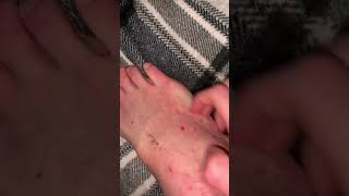 eczema scratching on feet and legs asmr