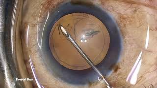 Pseudoexfoliation ring to guide capsulorhexis 👉