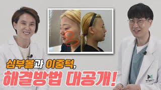 [얼굴지방흡입] 심부볼과 이중턱 해결방법 대공개!  수술 전후 브이로그와 실리프팅 효과 얼마나 좋을까