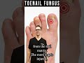 How to Know If Toenail Fungus is Dying? [How Fast Do Nails Grow?]