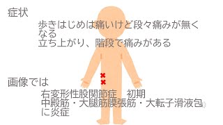 股関節外側の痛み　股関節臼蓋形成不全による変形性股関節症　初期