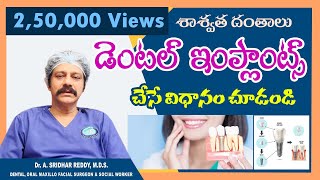 డెంటల్ ఇంప్లాంట్స్ చేసే విధానం ! Placement of Dental Implants - Demo by Dr Arumalla Sridhar Reddy