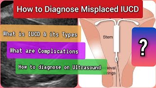 What is Misplaced IUCD \u0026 how to diagnose on Ultrasound? #health #medical #ultrasound #diagnosis