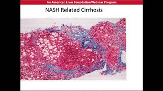 NASH Disease Overview