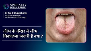 जीभ के कैंसर में जीभ निकालना जरूरी है क्या? | Tongue Cancer In Hindi | Dr Amit Chakraborty, SSO