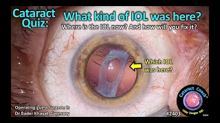 CataractCoach™ 2403: CataractQuiz: What type of IOL was here? And where did it go?