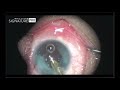 PPC device for challenging cataract surgery cases - Supplementary video 3 [ID 217919]