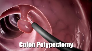 Removing a polyp from the colon (3D Animation)