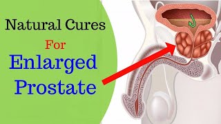 How to Treat An Enlarged Prostate | 5 Natural Remedies for an Enlarged Prostate.