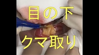 目の下の膨らみ取り【閲覧注意】【手術動画】（脂肪、クマ）・経結膜的眼窩脂肪除去術①