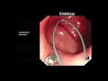 duodenal polypectomy