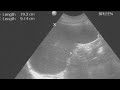 Spleen. Ultrasound Basics To Its Scanning.