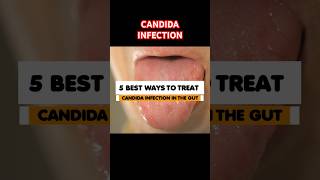 🦠 How to Treat Candida Infection in Gut 😷 #candida #stomach #shorts