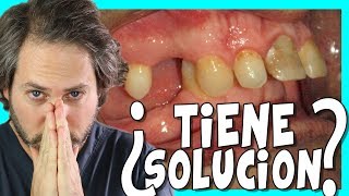 👉BRACKETS👈para dientes superiores ADELANTADOS. tratamiento CLASE 2  ORTODONCIA ANTES Y DESPUES