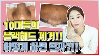 10대들의 블랙헤드제거!! 어떻게 하면 될까?!! 피부좋아지는법 꿀팁 공개!!!