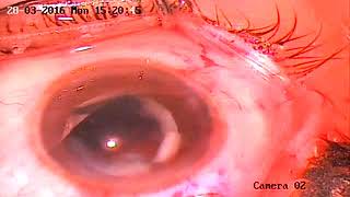 AIOC 2017 - Jaipur - VT14 - Cataract Surgery in Pre Existining Posterior Capsular Tear