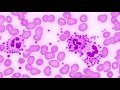 Thrombocytopenia | PSEUDOTHROMBOCYTOPENIA |  - WHY ARE THERE artificially low platelet numbers ??