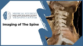 Imaging of The Spine