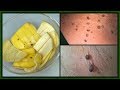 HOW TO GET RID OF SKIN TAGS | BANANA + APPLE CIDER VINEGAR GET RID OF SKIN TAGS FAST |Khichi Beauty HOW TO GET RID OF SKIN TAGS | BANANA + APPLE CIDER VINEGAR GET RID OF SKIN TAGS FAST |Khichi Beauty