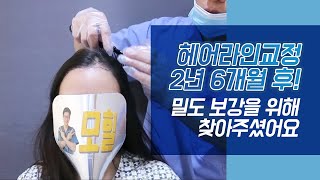 [모힐TV]헤어라인교정 2년 후, 헤어라인 정리 하러 오셨어요