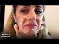 What It’s Like To Get A Chemical Peel For Acne Scars | Beauty Explorers | Beauty Insider