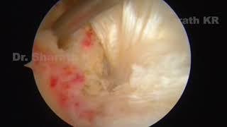 arthroscopic ACL reconstruction using arthrex tightrope