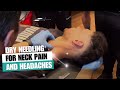How to use dry needling for #neck pain and #headaches