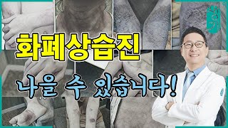 진물과 가려움의 고통 화폐상습진, 완치는 가능한걸까요?