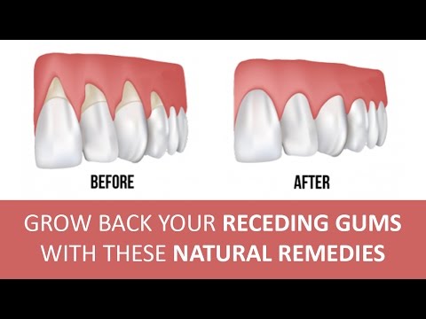 5 Effective Home Remedies for Gum Disease 5 Effective Home Remedies for Gum Disease