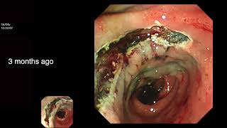 TRICKY DUODENAL POLYPECTOMY USING DUODENOSCOPE