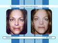 microdermabrasion with o2 facial with atoxolene instant resurfacing u0026 face lifting