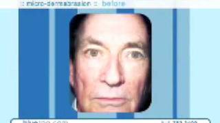 Microdermabrasion with O2 Facial with Atoxolene Instant Resurfacing \u0026 Face Lifting