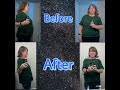 Vertical Sleeve Gastrectomy - 1 Year Post Op