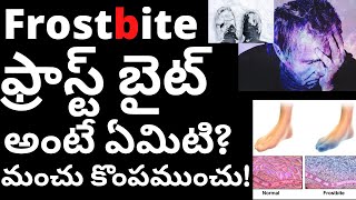 What is Frostbite? ఫ్రాస్ట్ బైట్ అంటే ఏమిటి? కొంపముంచే మంచు!  Tmixture Channel