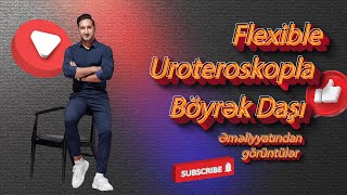 Flexible uroteroskopla böyrək daşı