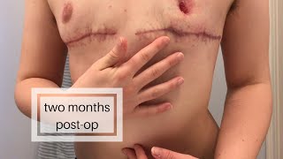 two months post-op double incision top surgery