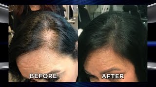 Could Microblading Your Scalp Help with Hair Loss?