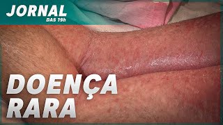 👉🏻🙎🏻‍♀💉👨🏻‍✈ Urgente! Menina de Erechim que tem síndrome rara precisa de ajuda  - Jornal das 19H.