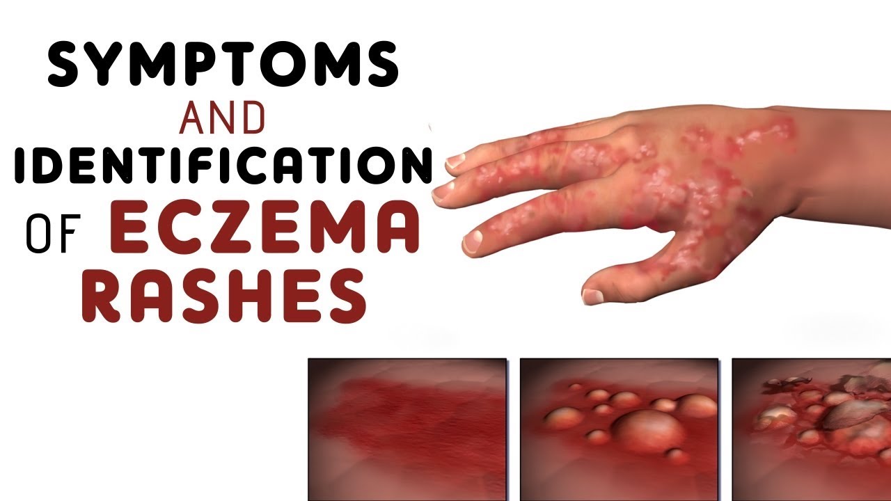 7 Types Of Eczema