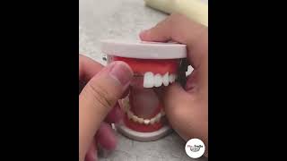 Moldable Teeth Filler !! Result in Minutes !! FixmySmile