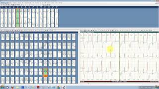 Typcial ECG analysis with ECGpro Holter 7.43