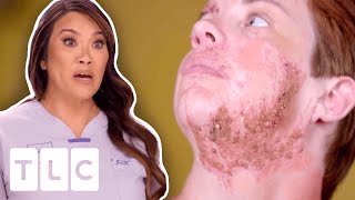 Dr. Lee Treats Thousands Of Moles On This Patient’s Face I Dr. Pimple Popper: This Is Zit